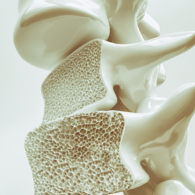 Illustration of osteoporosis in spine